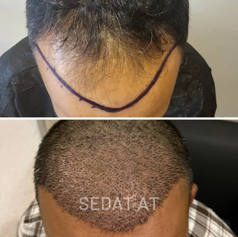 Trend Hair Çorlu Saç Ekim Merkezi - Öncesi/Sonrası 3