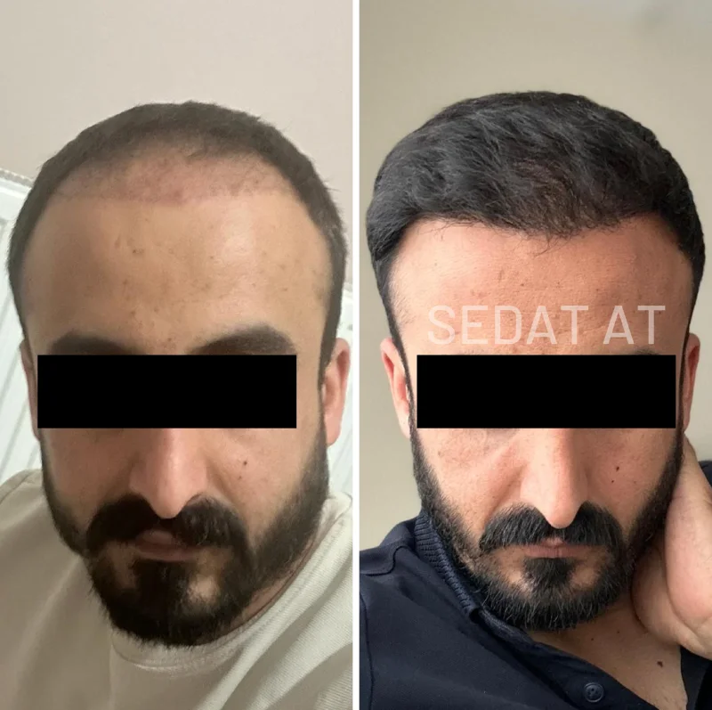Trend Hair Çorlu Saç Ekim Merkezi - Öncesi/Sonrası 5