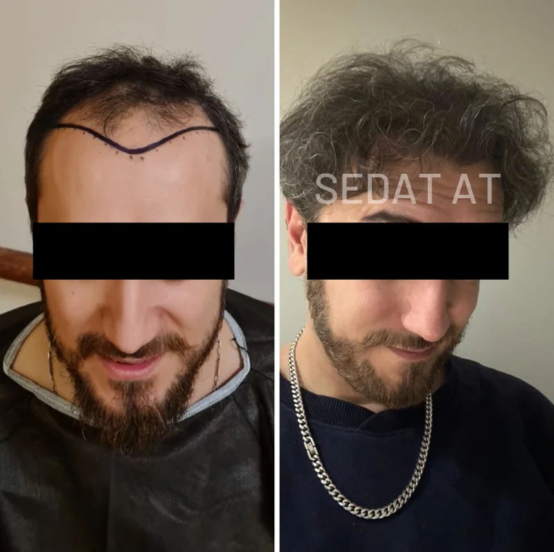 Trend Hair Çorlu Saç Ekim Merkezi - Öncesi/Sonrası 7