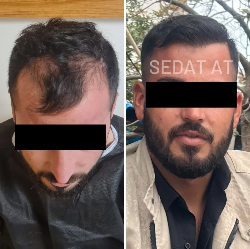 Trend Hair Çorlu Saç Ekim Merkezi - Öncesi/Sonrası 9