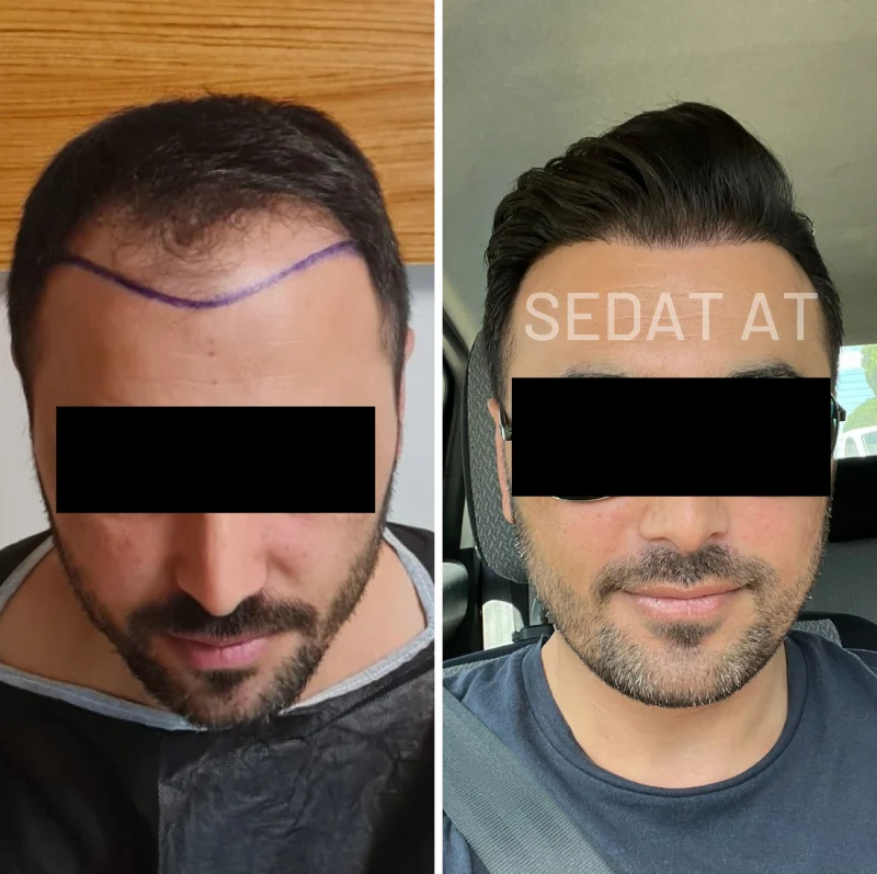 Trend Hair Çorlu Saç Ekim Merkezi - Öncesi/Sonrası 10