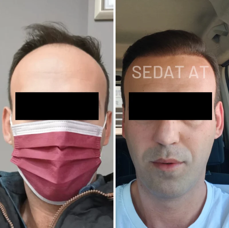 Trend Hair Çorlu Saç Ekim Merkezi - Öncesi/Sonrası 12