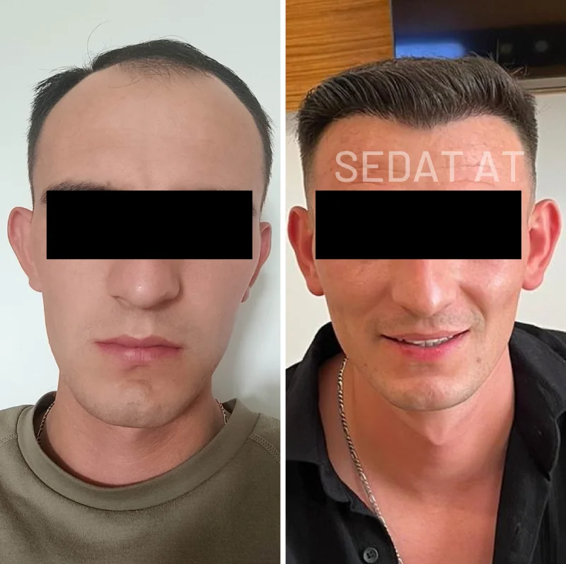 Trend Hair Çorlu Saç Ekim Merkezi - Öncesi/Sonrası 15