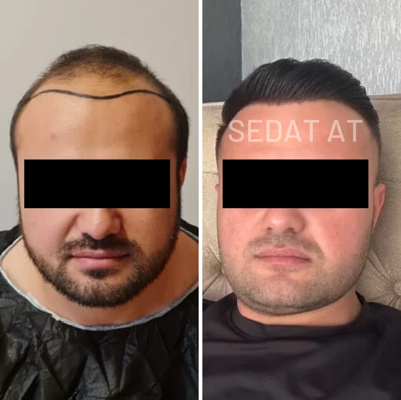 Trend Hair Çorlu Saç Ekim Merkezi - Öncesi/Sonrası 16