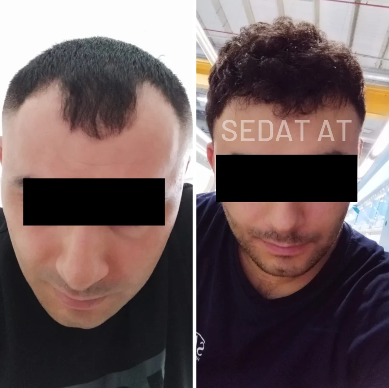 Trend Hair Çorlu Saç Ekim Merkezi - Öncesi/Sonrası 17
