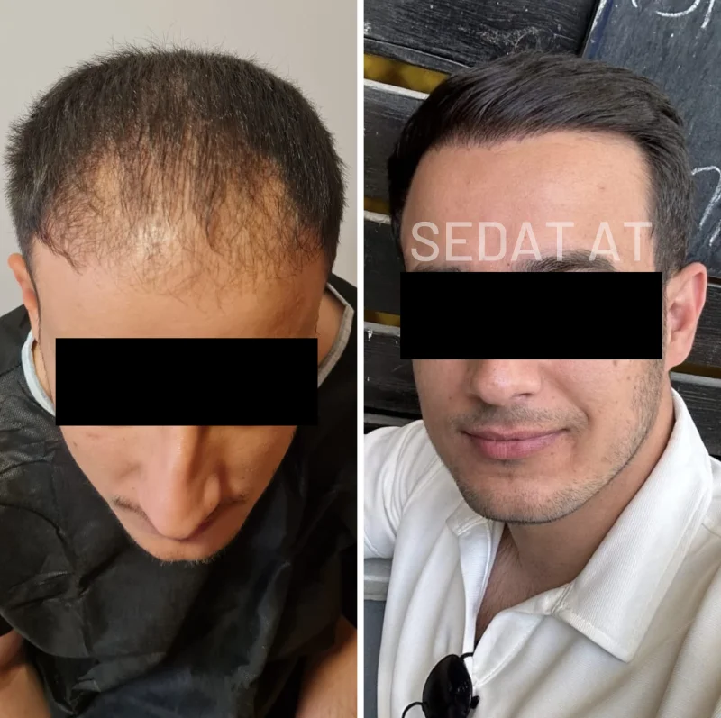 Trend Hair Çorlu Saç Ekim Merkezi - Öncesi/Sonrası 18