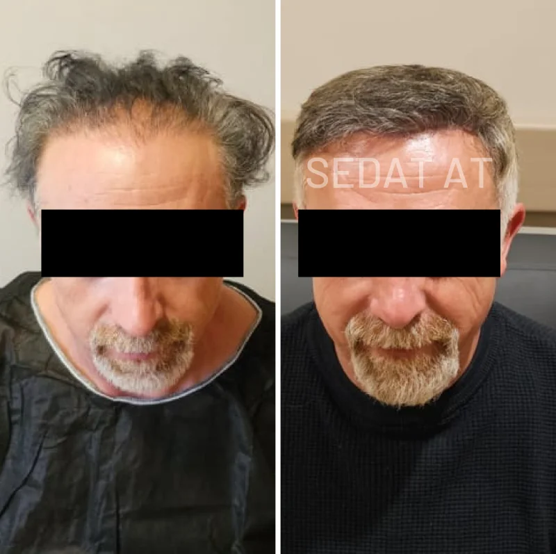 Trend Hair Çorlu Saç Ekim Merkezi - Öncesi/Sonrası 19