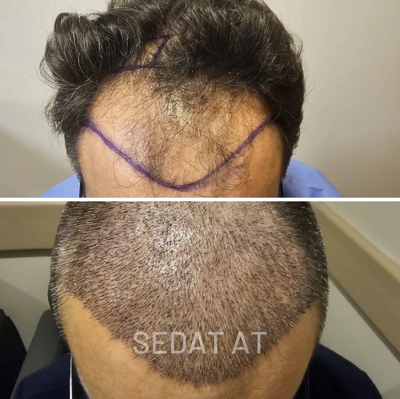 Trend Hair Çorlu Saç Ekim Merkezi - Öncesi/Sonrası 23