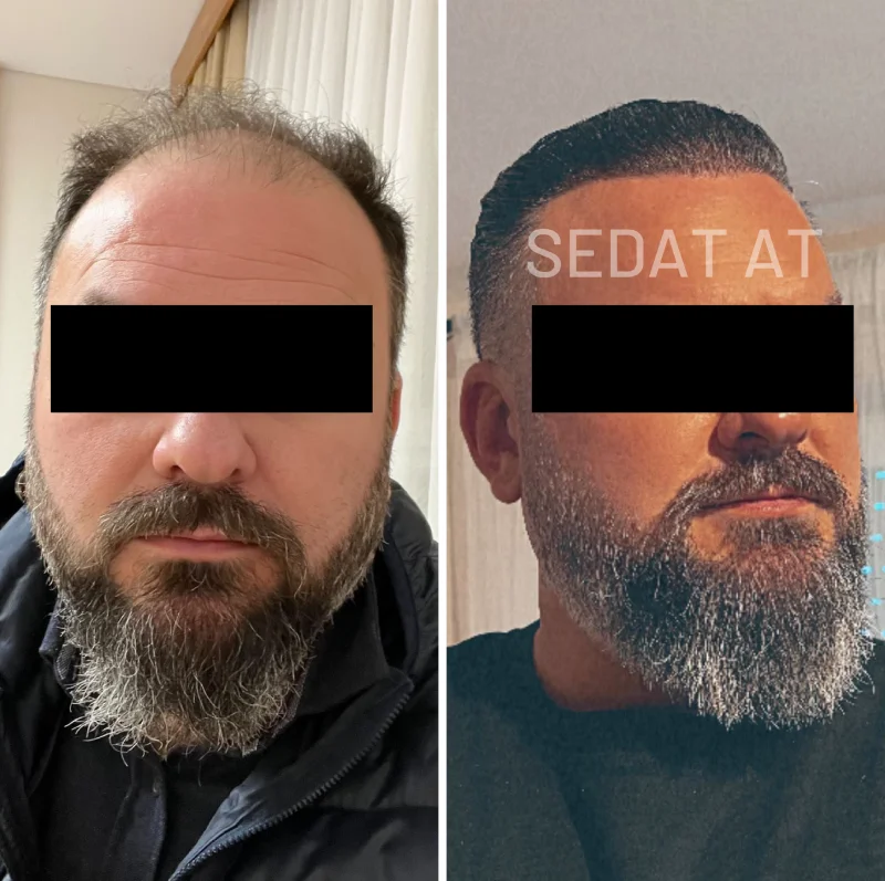 Trend Hair Çorlu Saç Ekim Merkezi - Öncesi/Sonrası 24