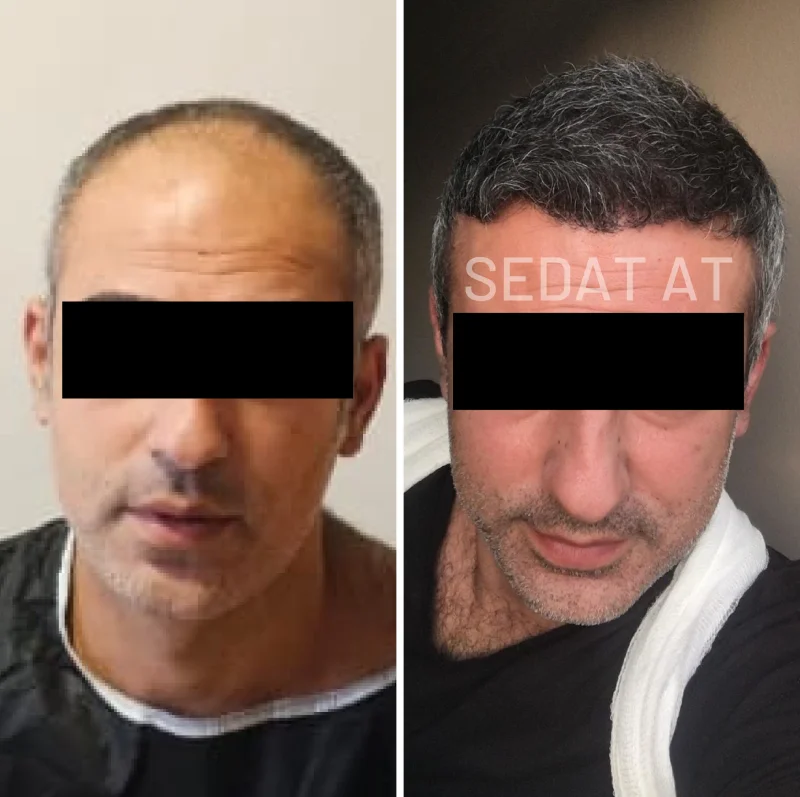 trendhair-oncesi-sonrasi-22