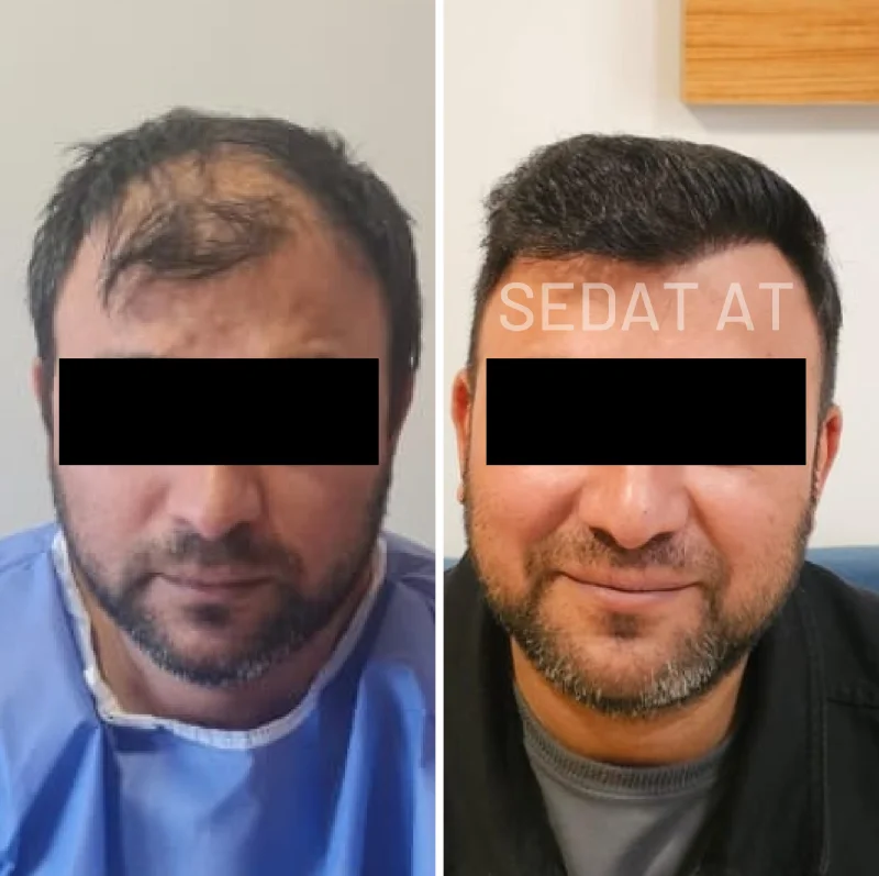 trendhair-oncesi-sonrasi-21