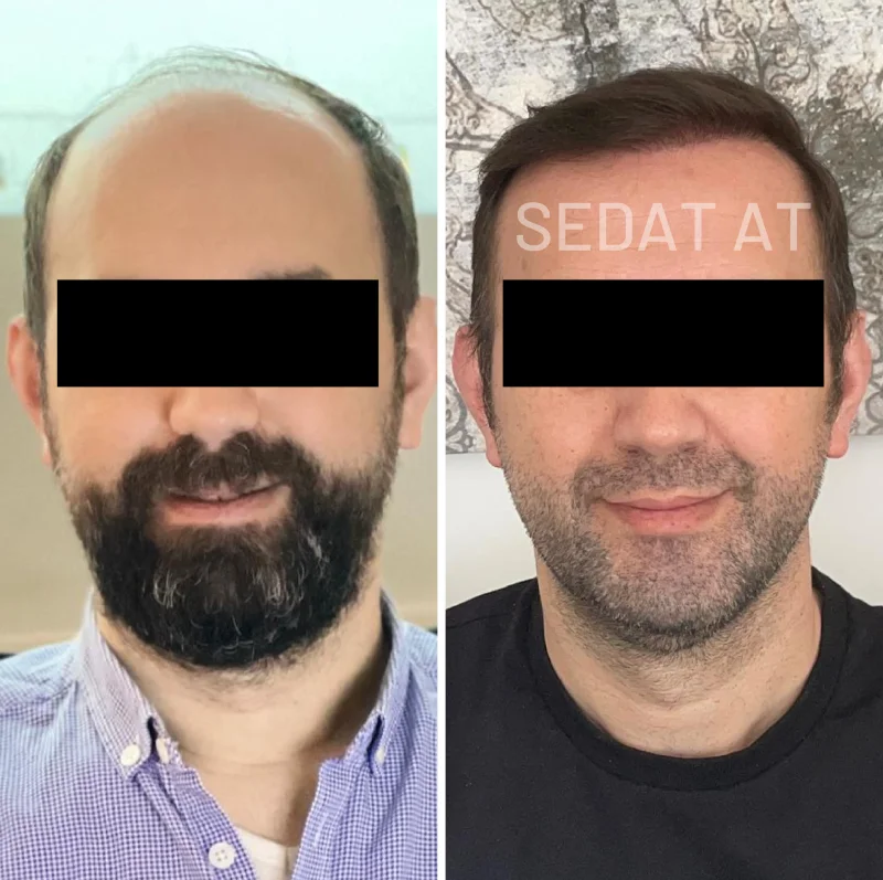 trendhair-oncesi-sonrasi-20
