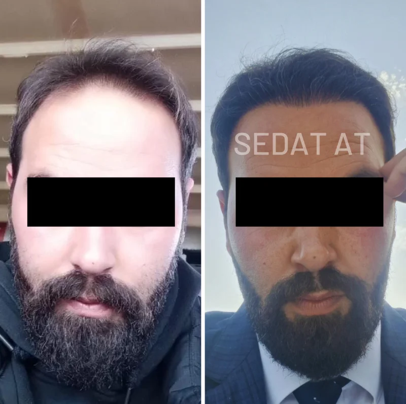 trendhair-oncesi-sonrasi-14