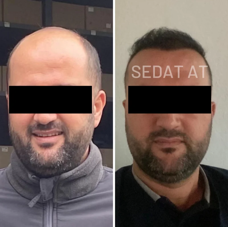 trendhair-oncesi-sonrasi-13