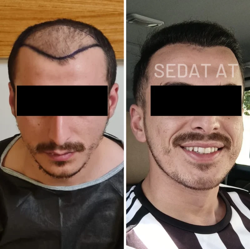 trendhair-oncesi-sonrasi-11
