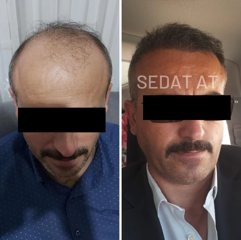 trendhair-oncesi-sonrasi-8