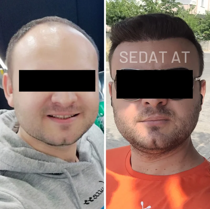 trendhair-oncesi-sonrasi-6