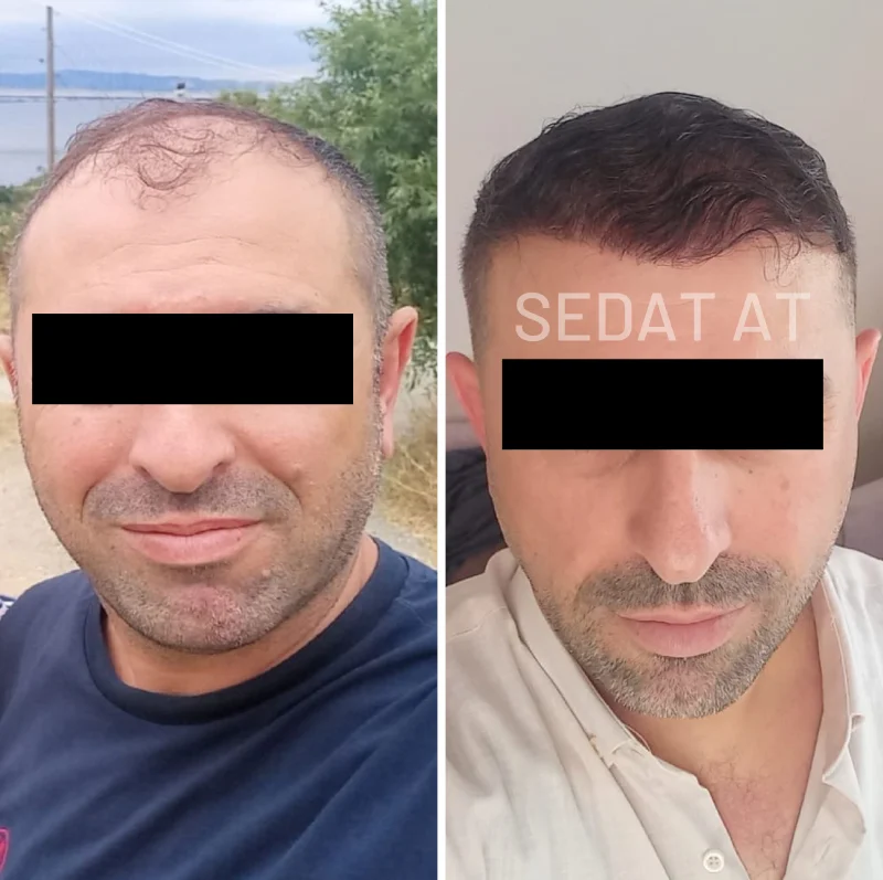 trendhair-oncesi-sonrasi-4